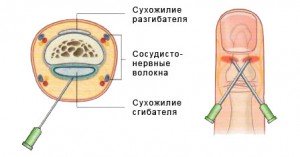 1333240875_4 Дечение нарыва вросшего ногтя