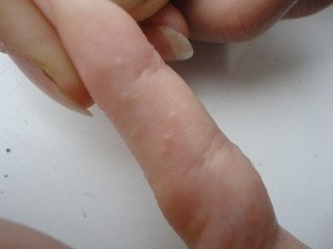 Дисгидроз лечение в Киеве