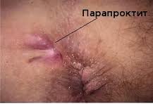 Болезни ануса