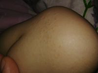 Мелкая красная сыпо по животу