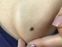 Мелкая красная сыпо по животу